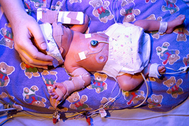 birth injury premature baby