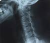 spinal cord xray